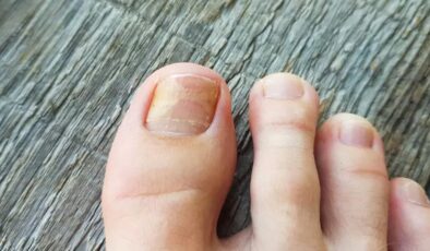 Tırnak mantarına doğal tahlil: 2 materyal yetiyor, mantardan eser kalmıyor