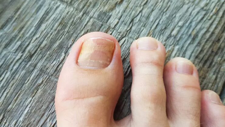 Tırnak mantarına doğal tahlil: 2 materyal yetiyor, mantardan eser kalmıyor